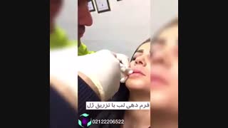 فرم دهی لب با تزریق ژل  در مطب پوست و زیبایی اُوکابویتی