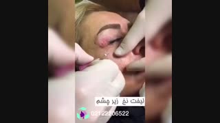 لیفت نخ زیر چشم در مطب پوست و زیبایی اُوکابویتی