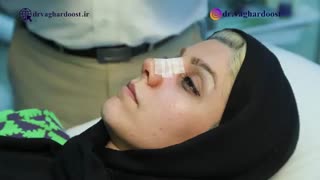 چسب زدن بینی