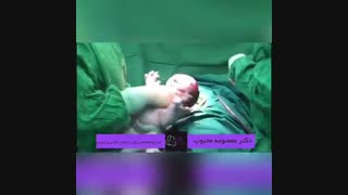زایمان سزارین