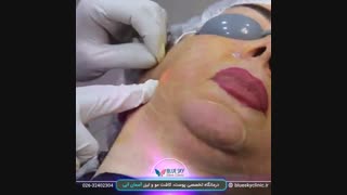 رفع غبغب و افتادگی پوست با اندولیفت - 02632402304