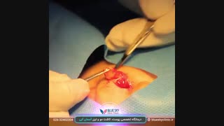 برداشت خال - 02632402304