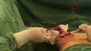 اصلاح پروتز عمل شده و لیفت سینه