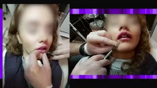 تزریق ژل