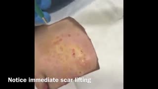 از بین بردن جای جوش با پانچ پوستی