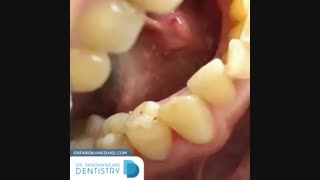 تعویض و ترمیم دندان های ترمیم شده