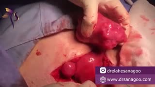 جراحی باز فیبروم ده سانتی