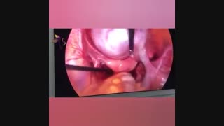 لاپاراسکوپی کیست ۹ سانتی تخمدان راست