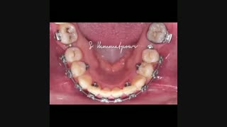 دستگاه TAD system ارتودنسی | دکتر همت پور
