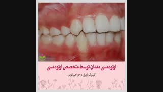 ارتودنسی توسط متخصص ارتودنسی در کلینیک توس