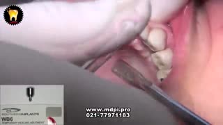 کاشت ایمپلنت دندان یک روزه در تهران