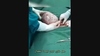 فیلم عمل جراحی کیست تخمدان
