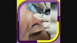 رفع تیرگی دور چشم
