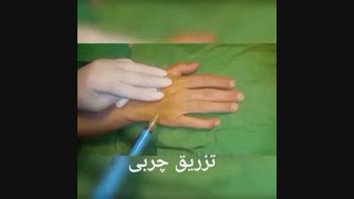 تزریق چربی - دکتر ابدالی - 22807060