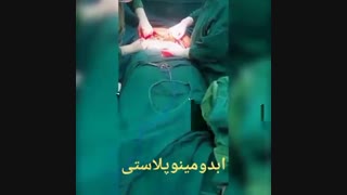 ابدومینوپلاستی - دکتر ابدالی - 22807060