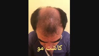 کاشت مو - دکتر ابدالی - 22807060