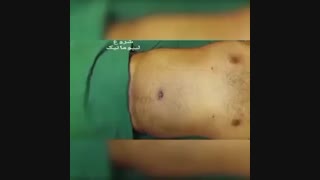 لیپوماتیک - دکترابدالی - 09123001619