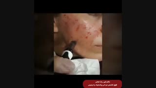 میکرونیدلینگ صورت برداشتن خال