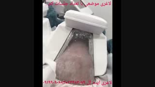 لاغری موضعی سریع با کرایولیپولیز