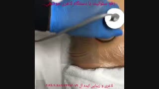 کویتیشن و لاغری موضعی