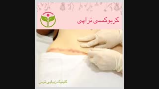 نحوه ی انجام کربوکسی تراپی