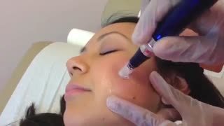 میکرونیدلینگ برای از بین بردن جای جوش صورت