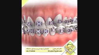 براکت توربو | دکتر لادن طیبی