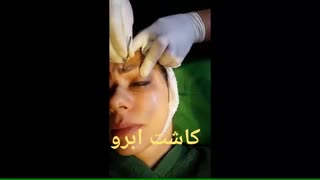 کاشت ابرو - دکتر ابدالی - 22807060