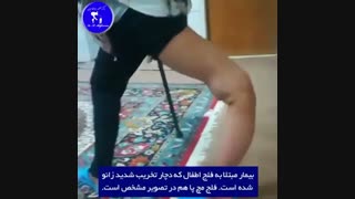 بیمار مبتلا به فلج اطفال