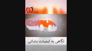 نگاهی به عملکرد ایمپلنت دندانی و نقش آن در زیبایی