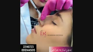 فیلم اصلاح فرم بینی بدون جراحی