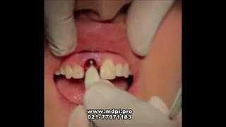 فیلم کاشت ایمپلنت دندان جلو