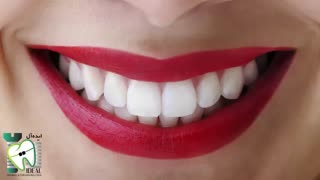 اصلاح طرح لبخند | کلینیک دندانپزشکی ایده آل