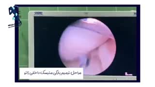 فیلم جراحی ترمیم پارگی منیسک زانو